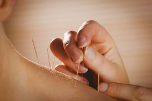 Acupuncture needles