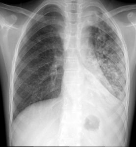 Chest X-ray showing tuberculosis
