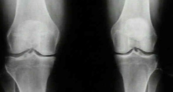 Knee X-ray